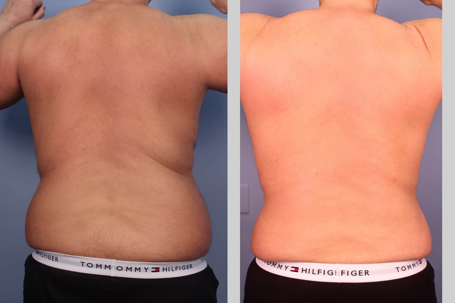 Before and after photo of Belt Lipectomy by a Toronto Plastic Surgeon. Image 36