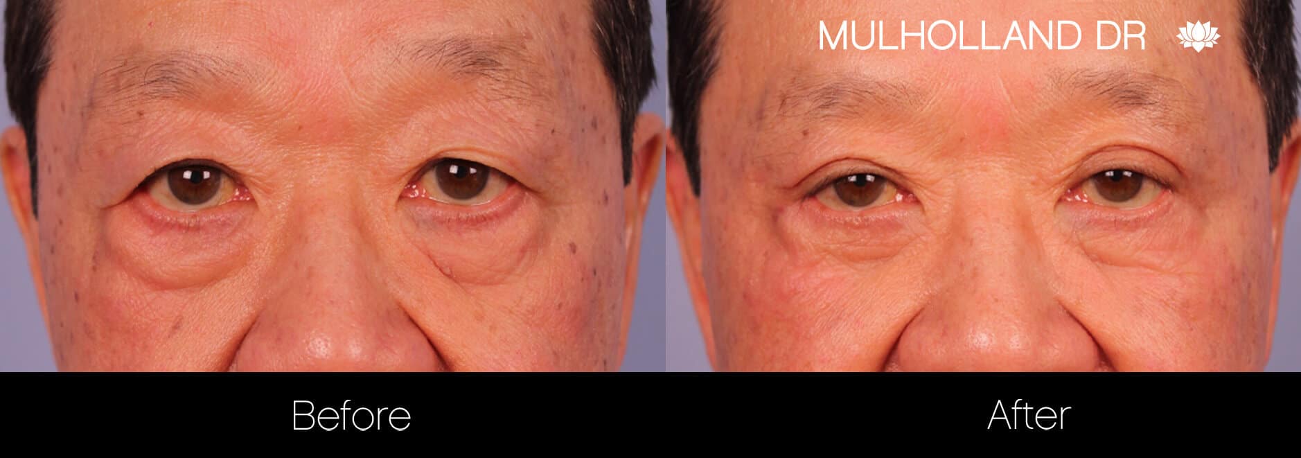 Double eyelid surgery before and after photo. Image 18