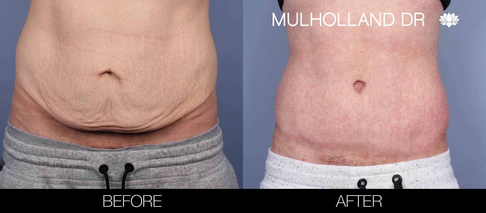 Before and after photos showing the reduction in stretch marks and improved contour of the abdomen following a belt lipectomy.