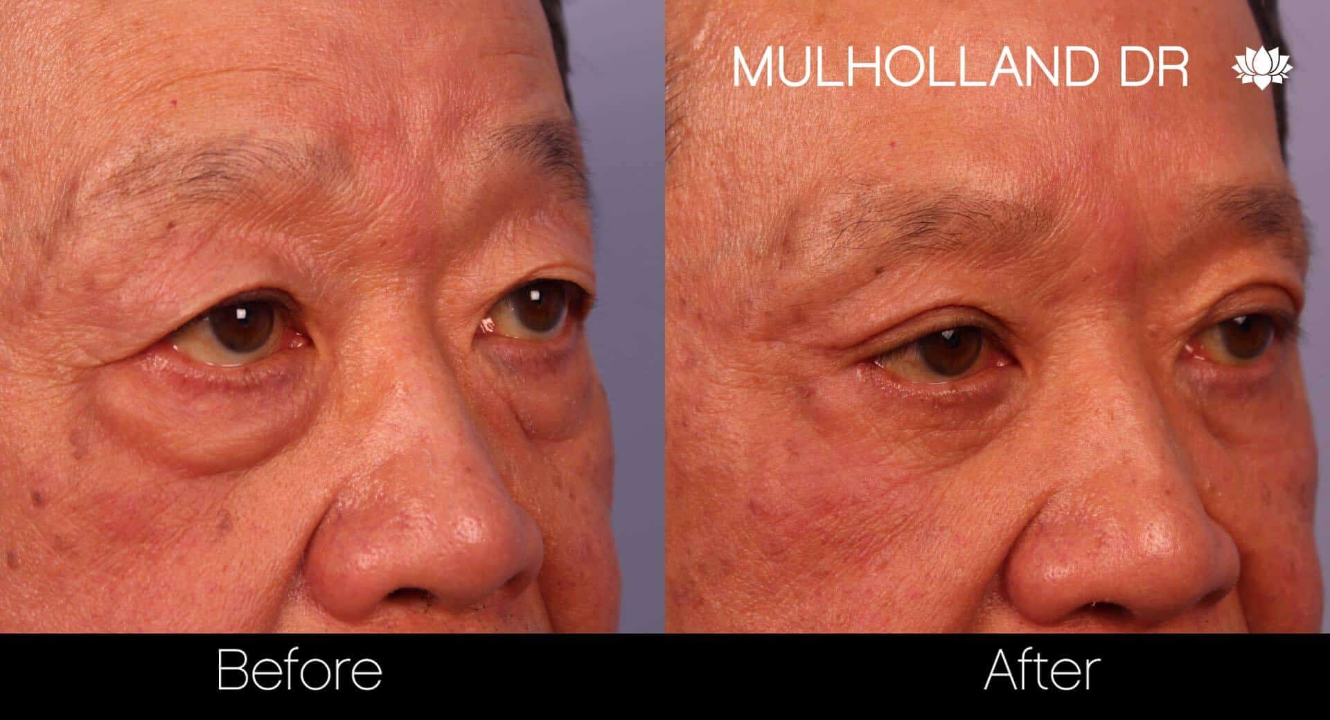 Double eyelid surgery before and after photo. Image 21