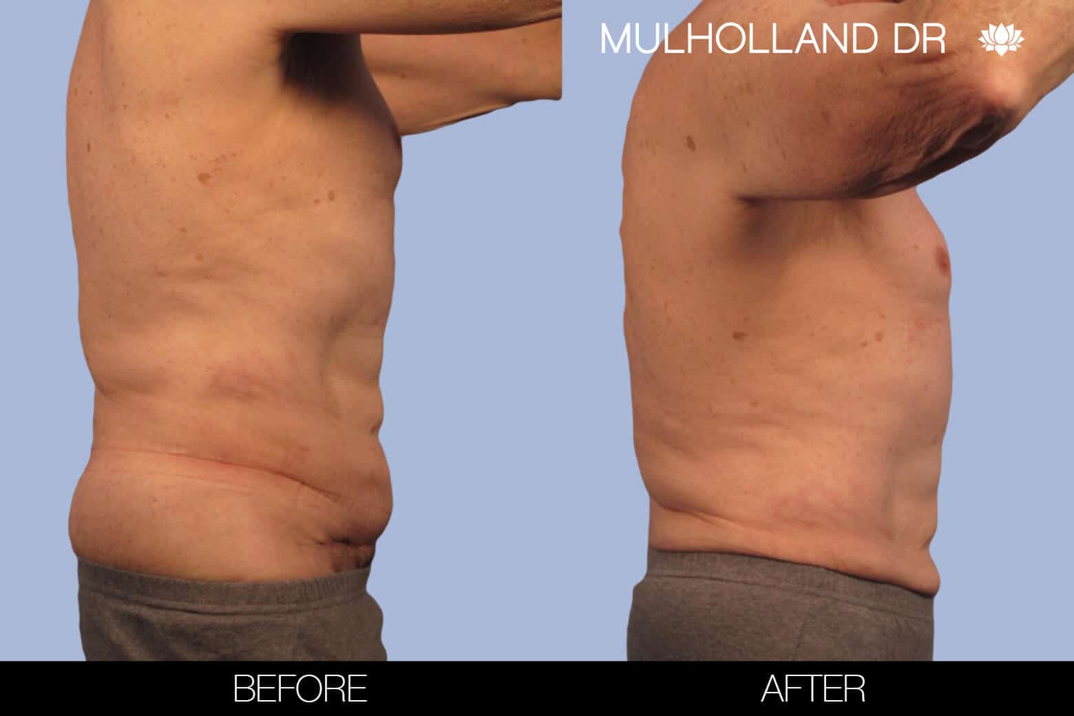 Before and after photo of Belt Lipectomy by a Toronto Plastic Surgeon. Image 31