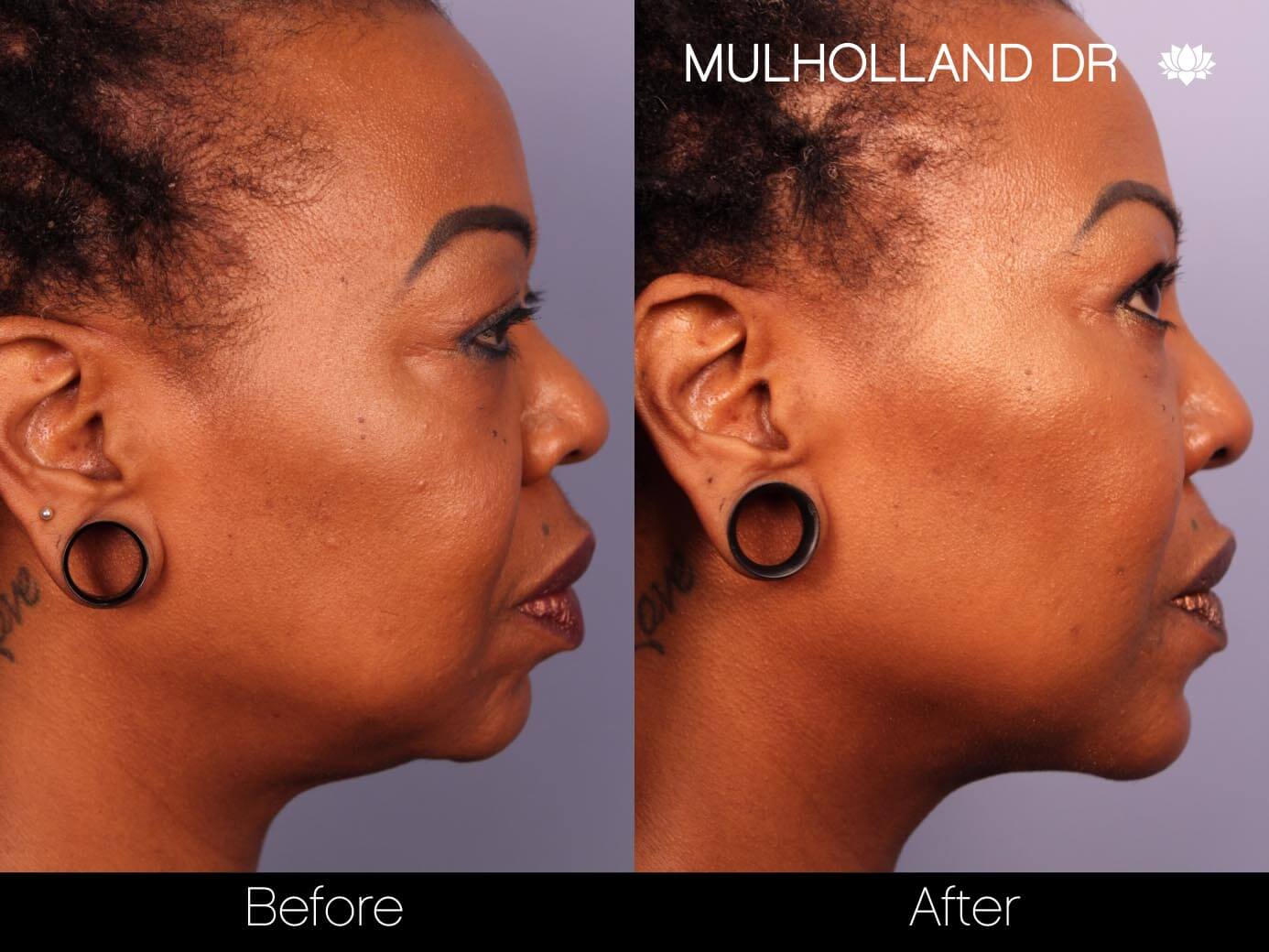 Before and after photo of a thread lift procedure in Toronto. Image 20