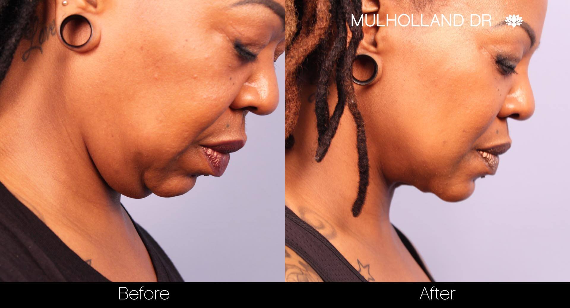 Before and after photo of a thread lift procedure in Toronto. Image 25