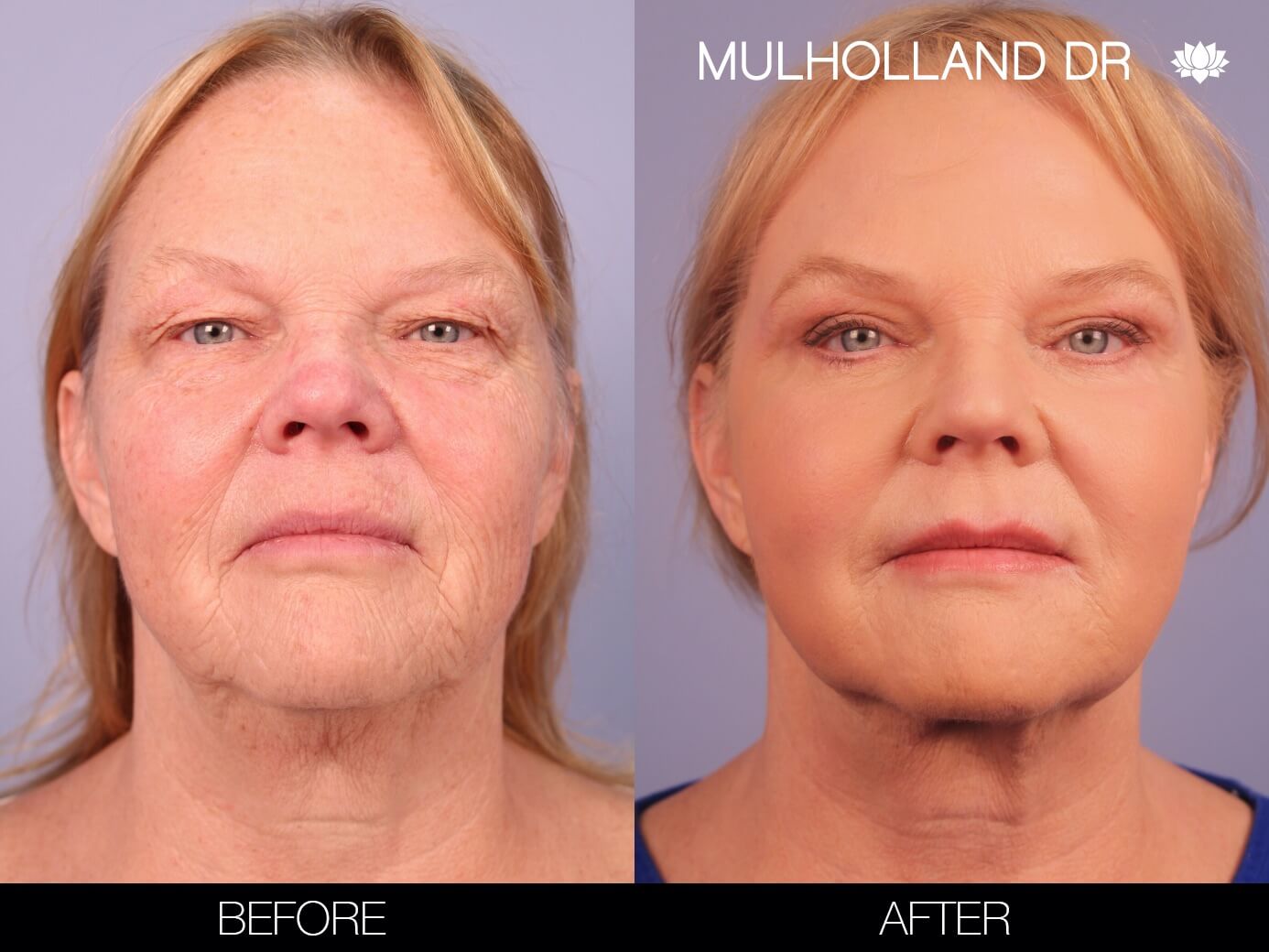 Before and after photo of a thread lift procedure in Toronto. Image 1