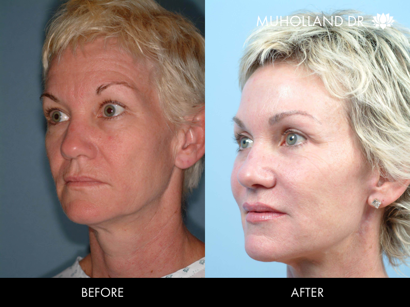 Before and after photo of a thread lift procedure in Toronto. Image 29