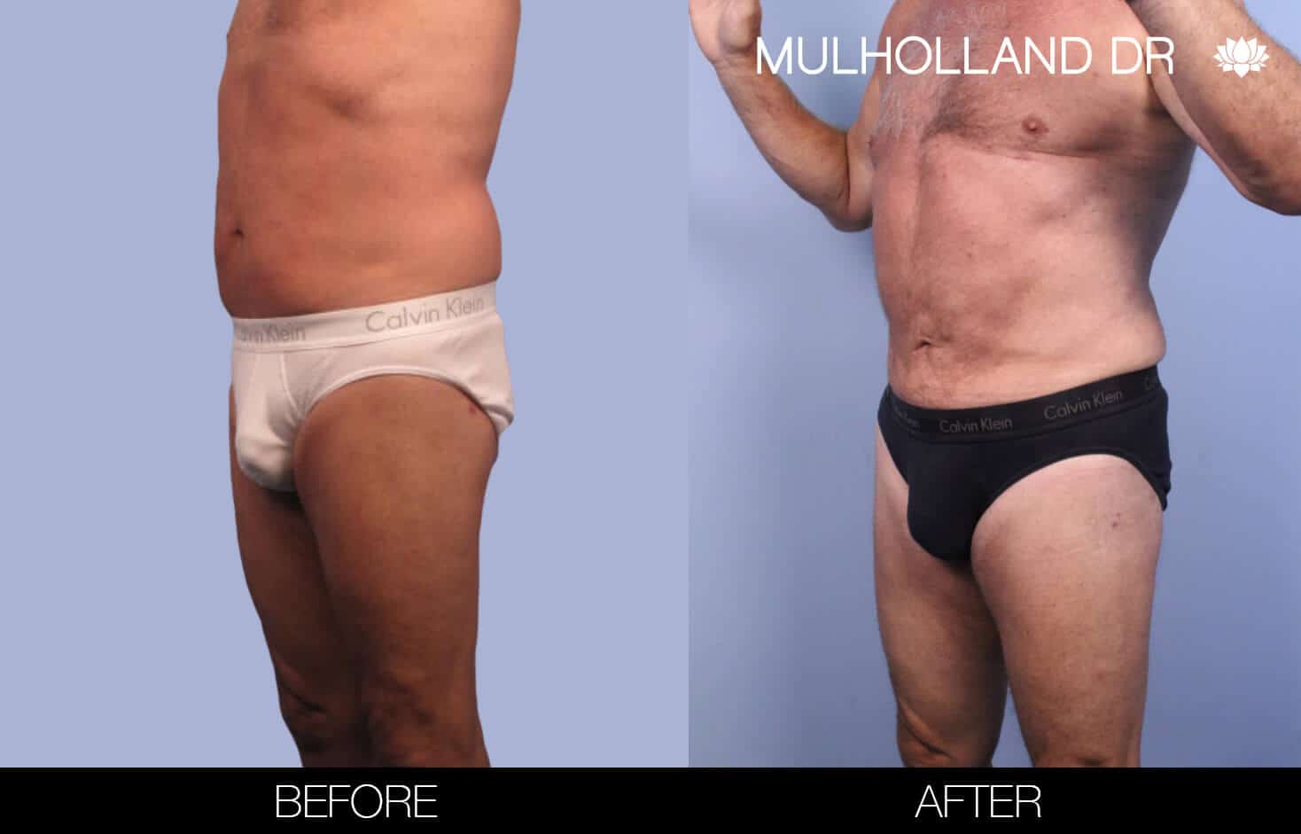 Before and after photo of Belt Lipectomy by a Toronto Plastic Surgeon. Image 27