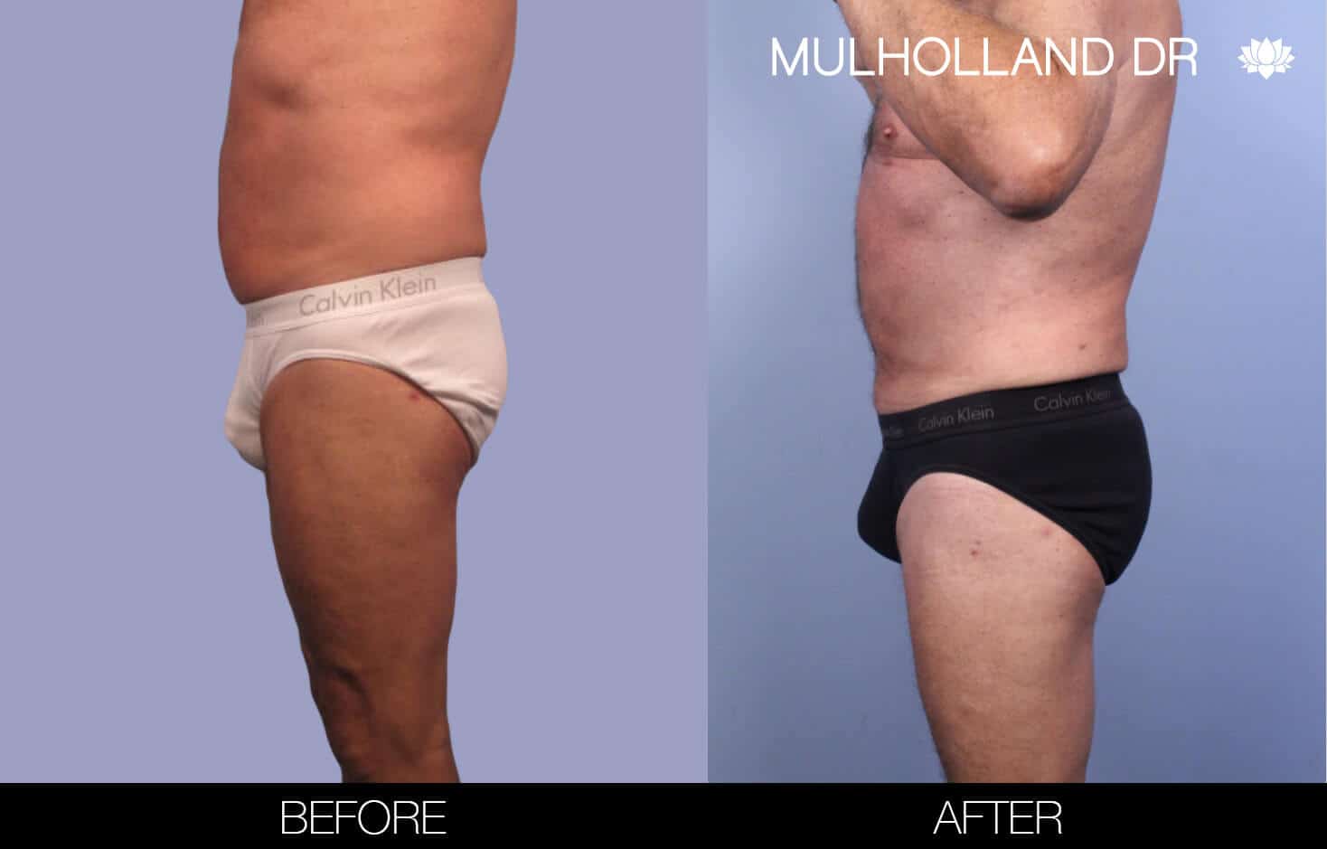 Before and after photo of Belt Lipectomy by a Toronto Plastic Surgeon. Image 26