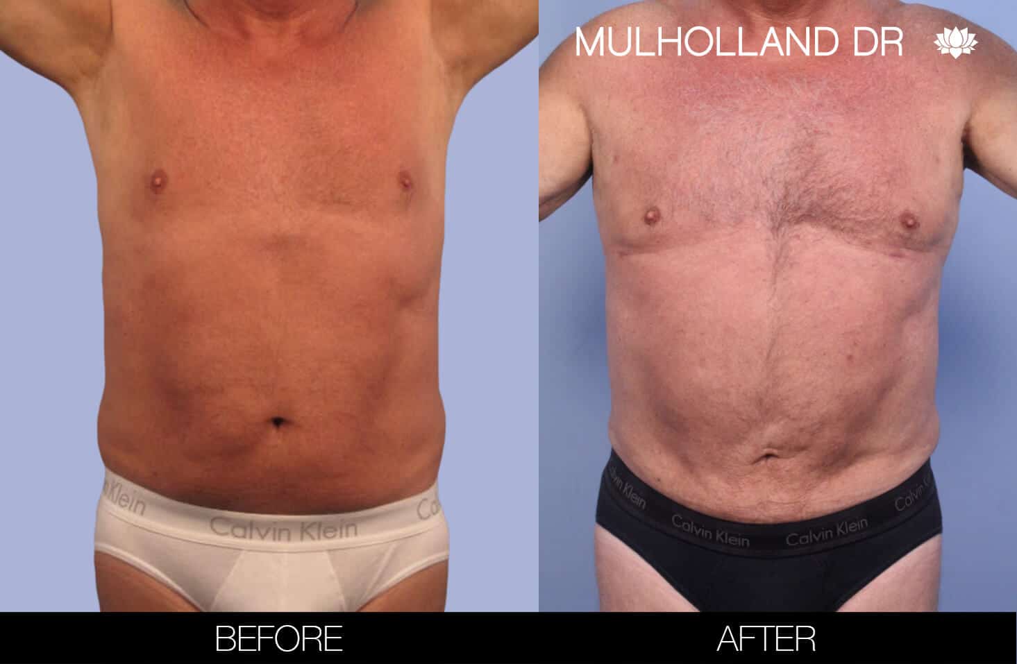 Before and after photo of Belt Lipectomy by a Toronto Plastic Surgeon. Image 24