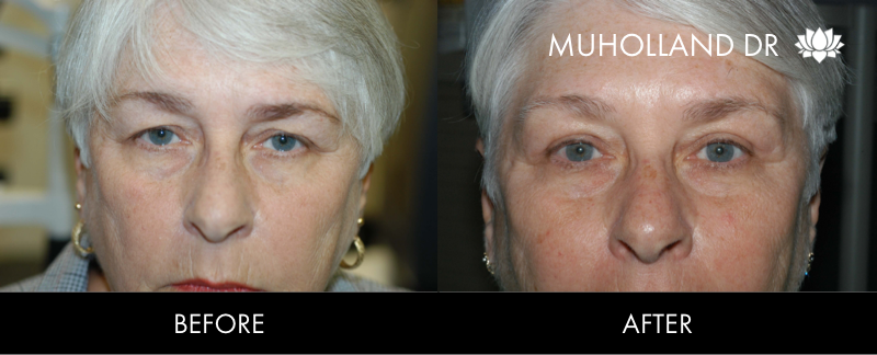 Before and after photo of a thread lift procedure in Toronto. Image 35