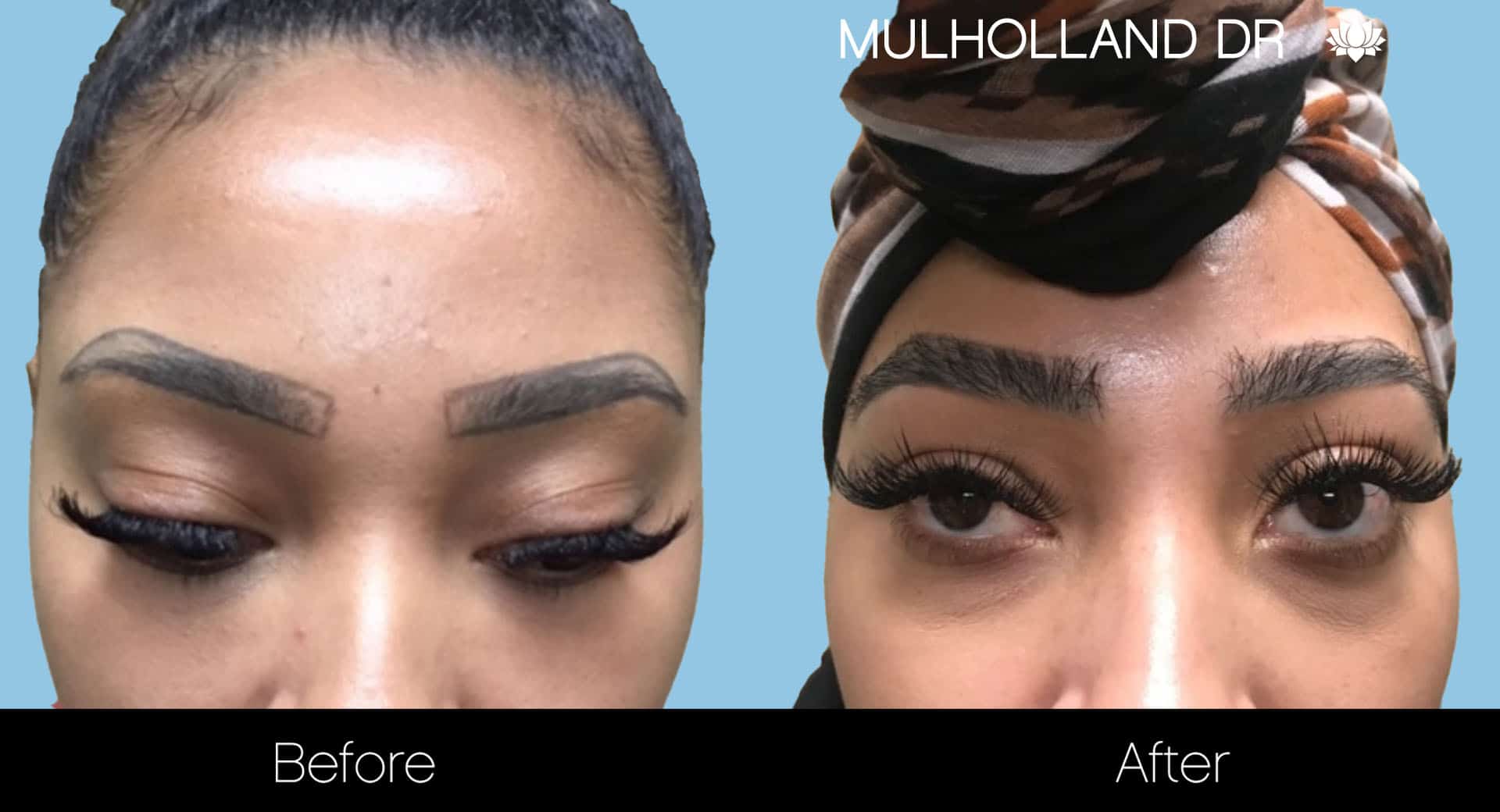 image3_surgical_eyebrows-FUE