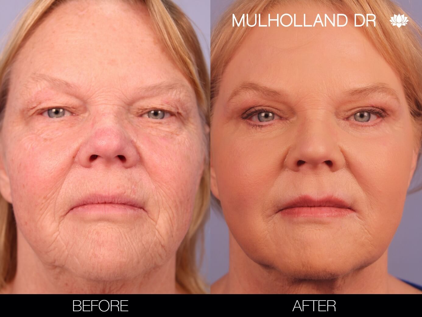 Before and after photo of a thread lift procedure in Toronto. Image 2