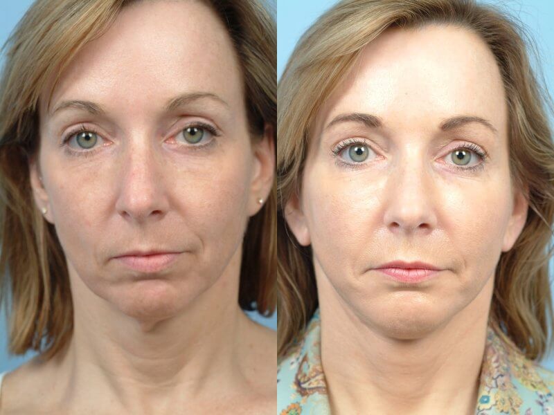 Before and after photo of a thread lift procedure in Toronto. Image 36