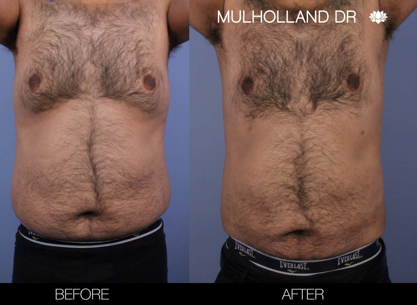 Before and after photo of Belt Lipectomy by a Toronto Plastic Surgeon. Image 16