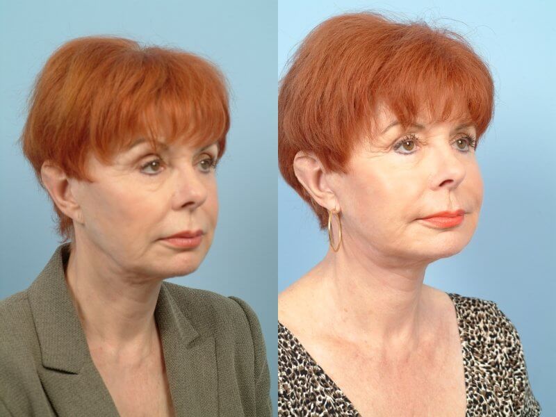 Before and after photo of a thread lift procedure in Toronto. Image 43