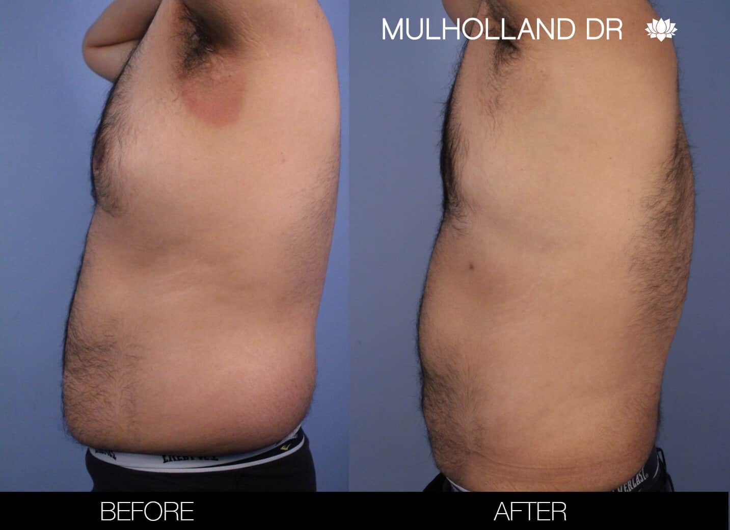 Before and after photo of Belt Lipectomy by a Toronto Plastic Surgeon. Image 14