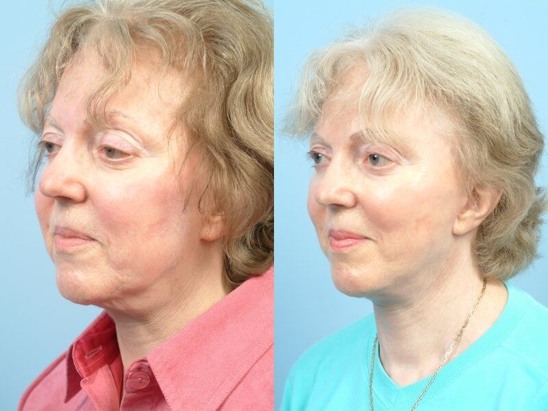 Before and after photo of a thread lift procedure in Toronto. Image 45