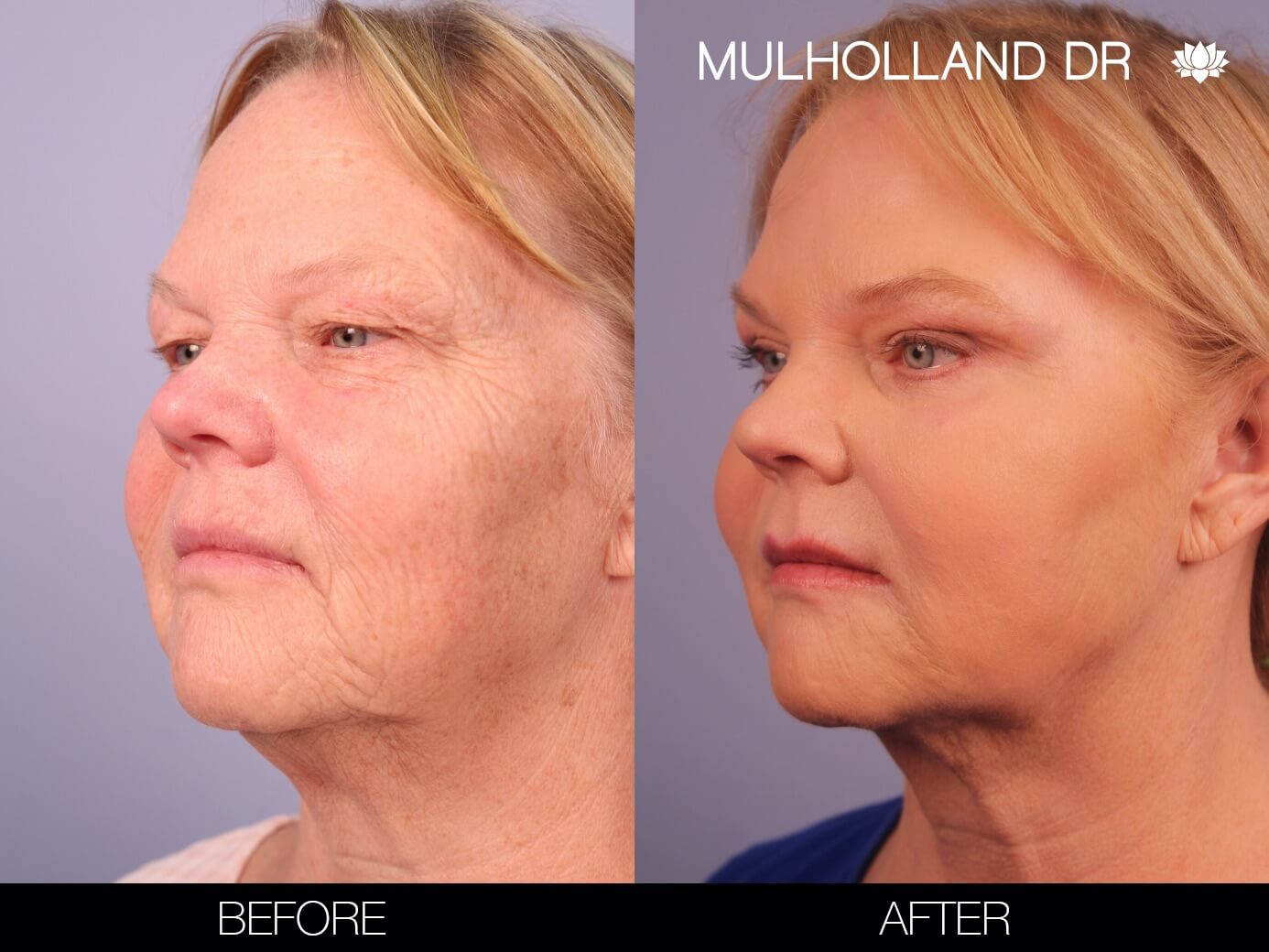 Before and after photo of a thread lift procedure in Toronto. Image 3