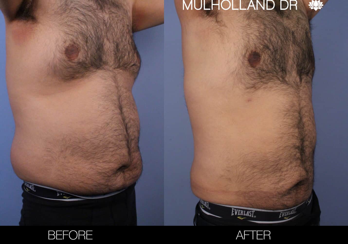 Before and after photo of Belt Lipectomy by a Toronto Plastic Surgeon. Image 13