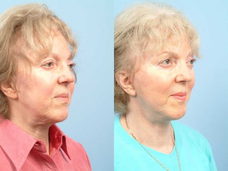 Before and after photo of a thread lift procedure in Toronto. Image 46