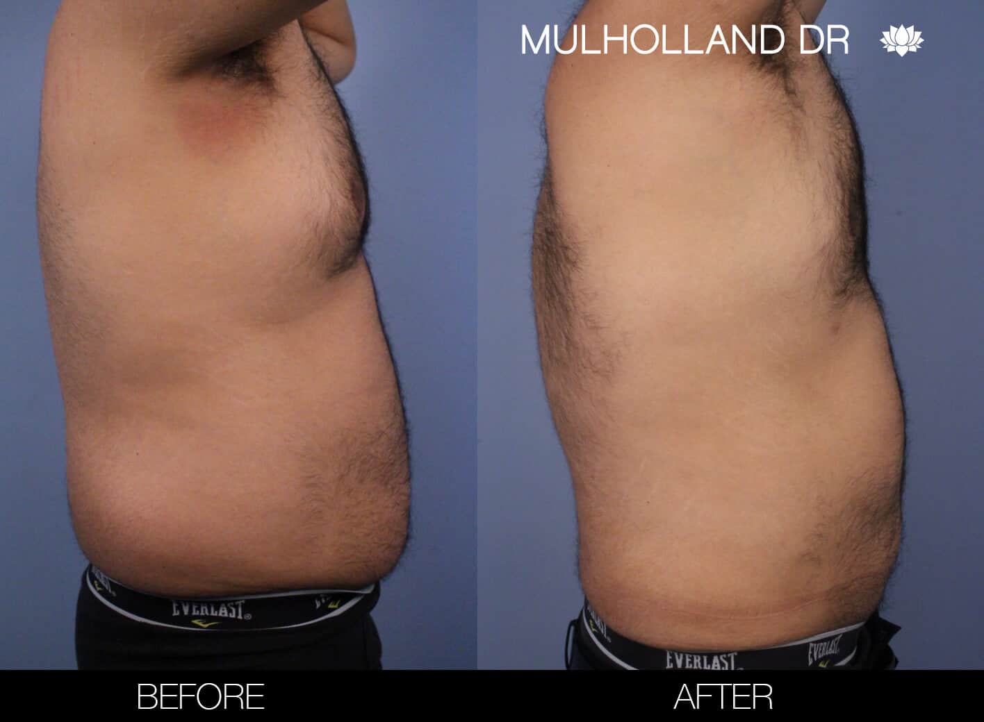 Before and after photo of Belt Lipectomy by a Toronto Plastic Surgeon. Image 12