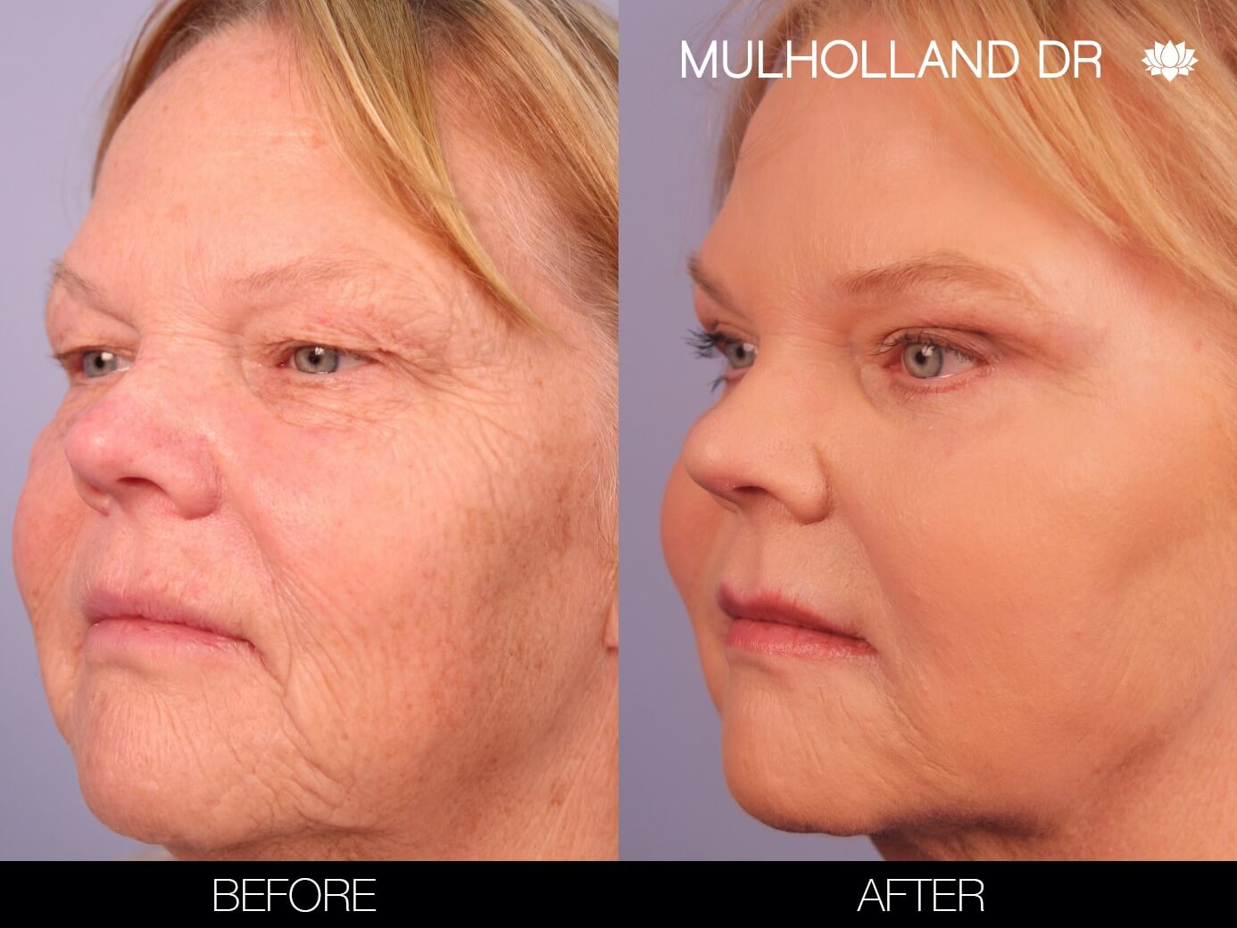 Before and after photo of a thread lift procedure in Toronto. Image 4