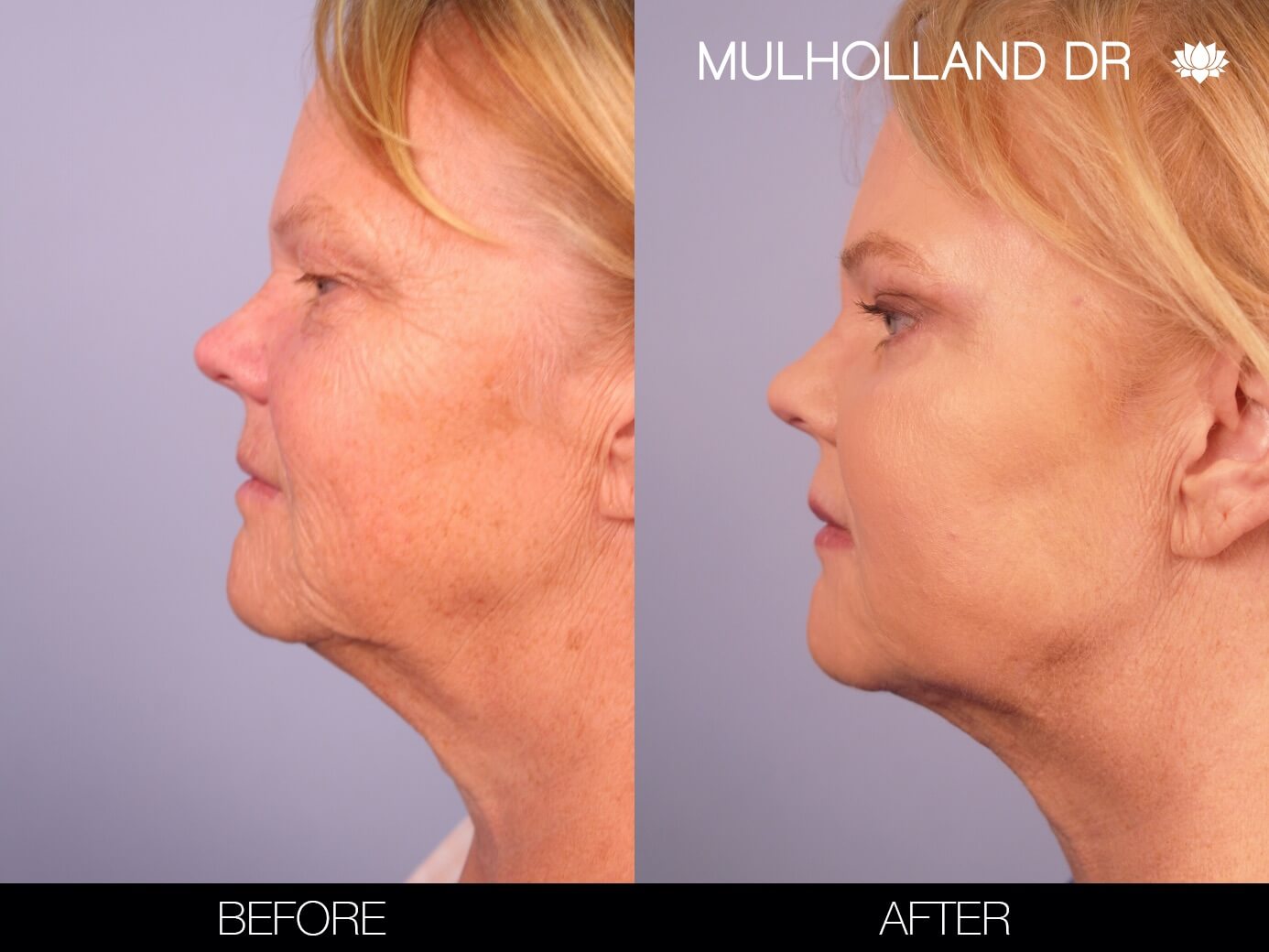 Before and after photo of a thread lift procedure in Toronto. Image 5