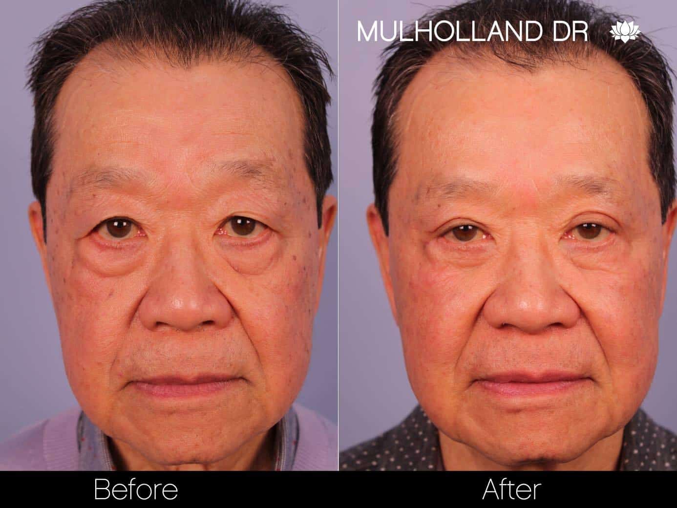 Double eyelid surgery before and after photo. Image 12