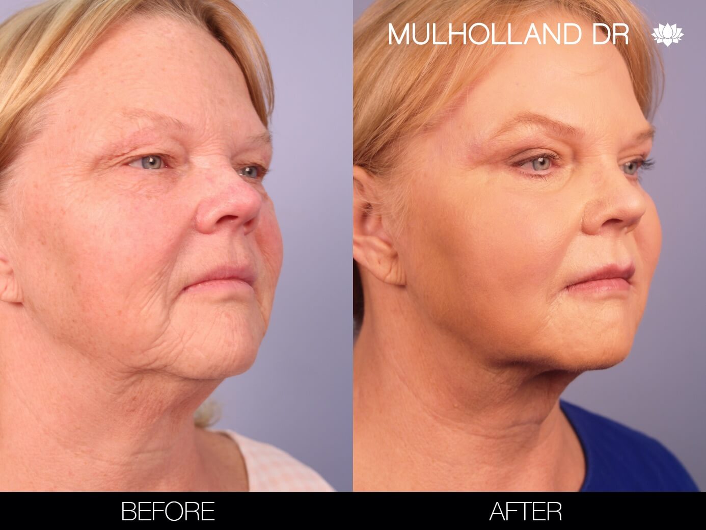 Before and after photo of a thread lift procedure in Toronto. Image 7