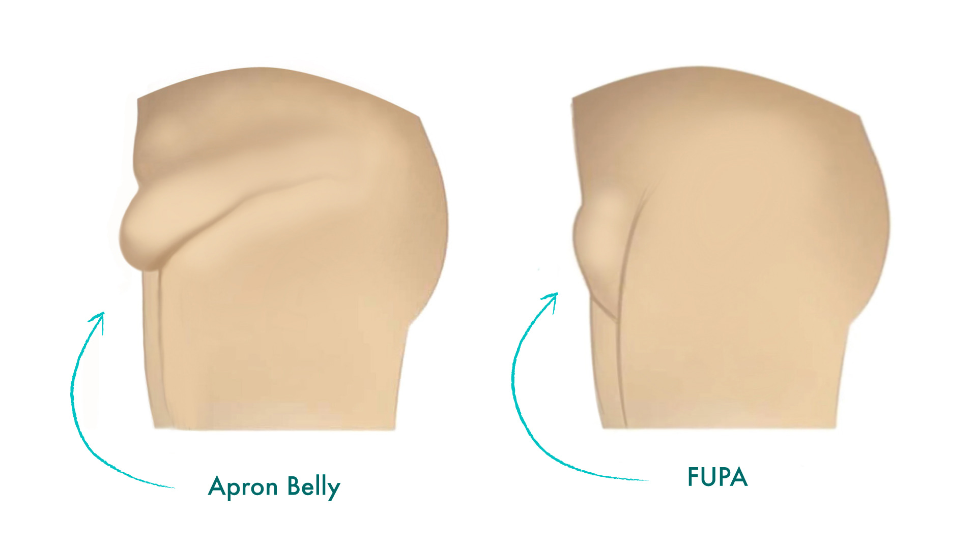 An infographic comparing “Apron Belly” and “FUPA”.