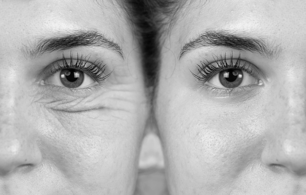 Image shows the reduction of wrinkles and sagging skin around the eyes, highlighting the rejuvenating effects of the procedure.