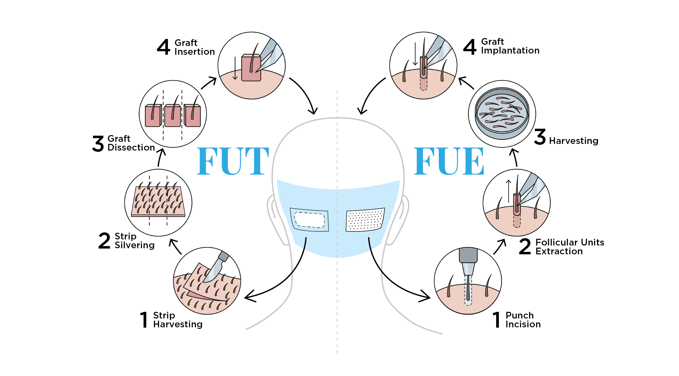 The image compares the steps of FUT (Follicular Unit Transplantation) and FUE (Follicular Unit Extraction) hair transplant techniques, illustrating the differences in harvesting and implantation processes.