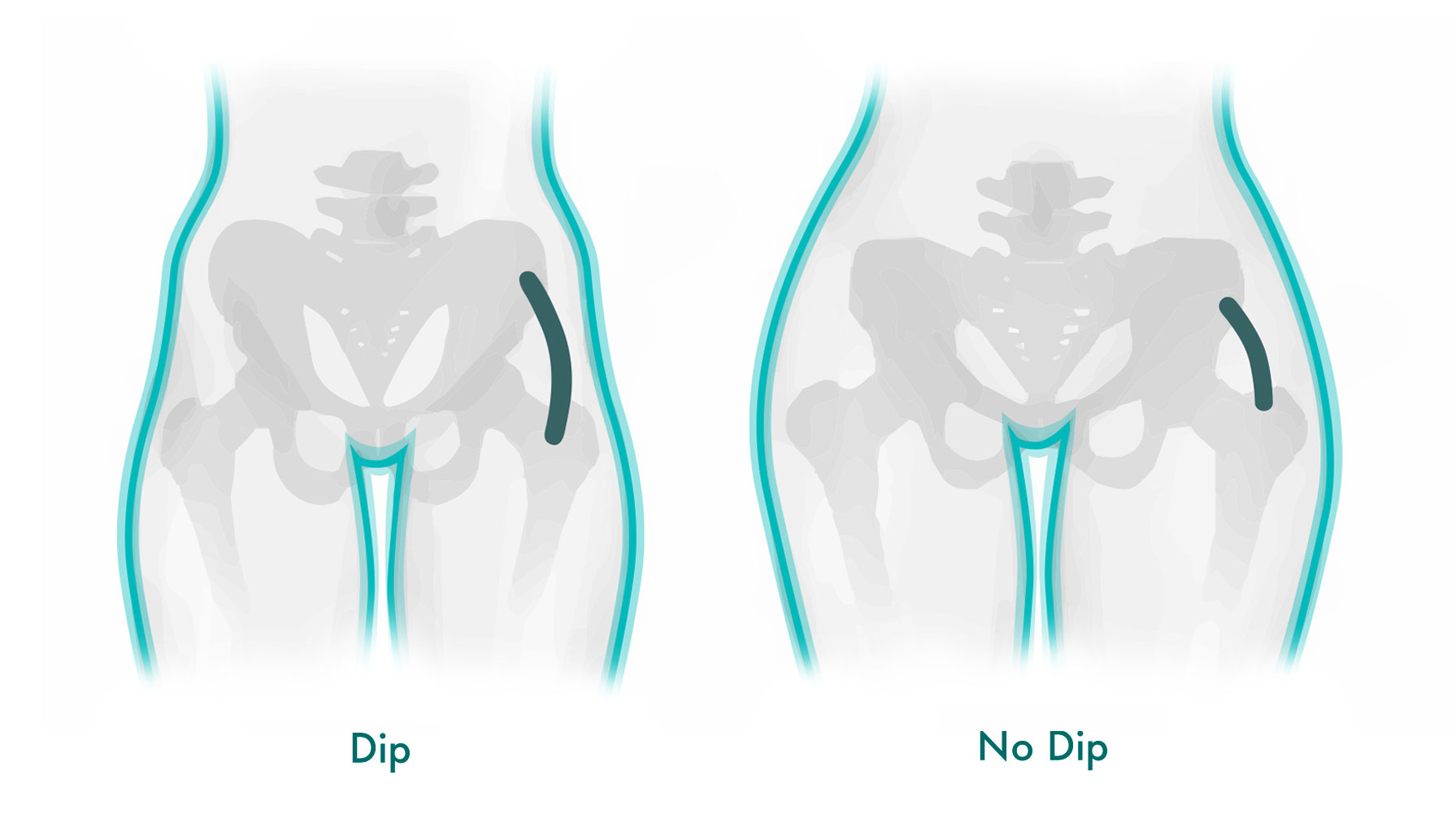 An infographic contrasting two body shapes, one with an inward curve below the hip, and the other with a smooth contour.