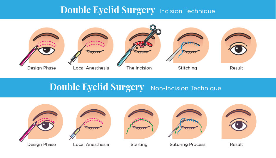 The image illustrates two techniques for double eyelid surgery: the incision technique and the non-incision technique