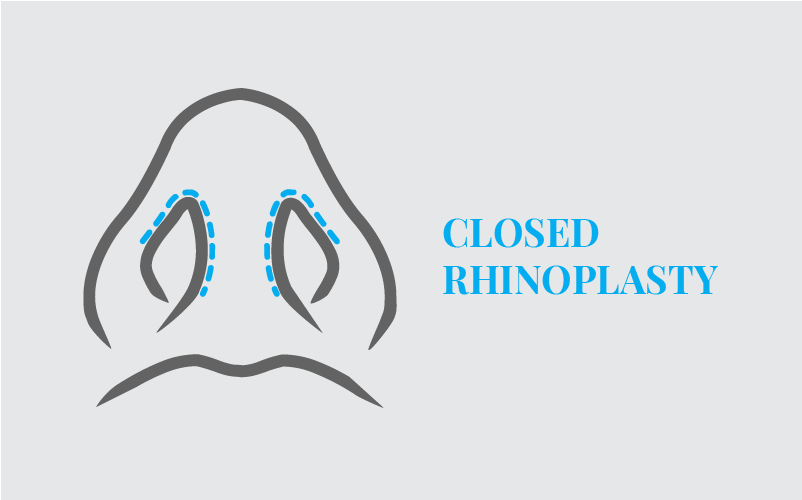 Depicts a rhinoplasty method where the incisions are made inside the nostrils.