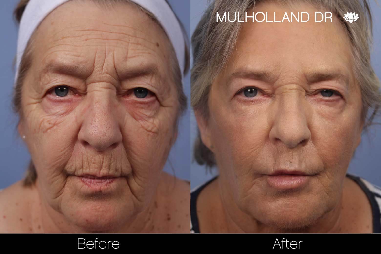 facial fat grafting before and after