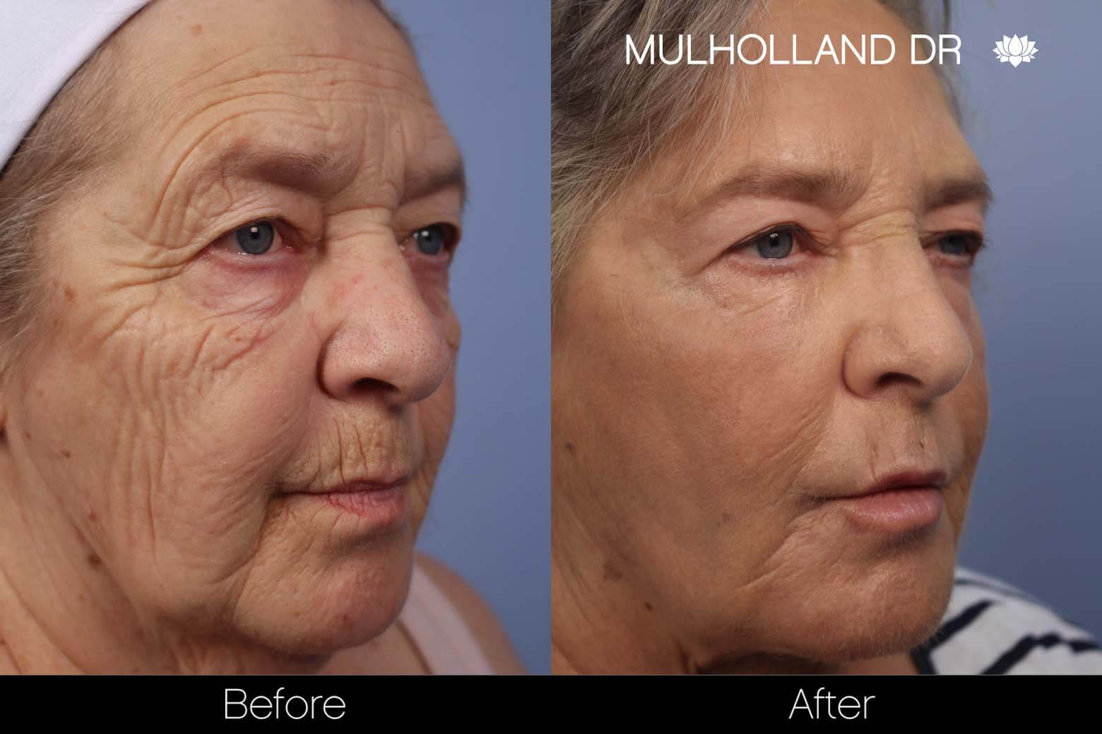 facial fat grafting before and after