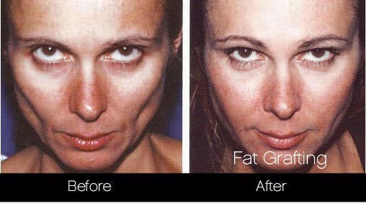 facial fat grafting before and after