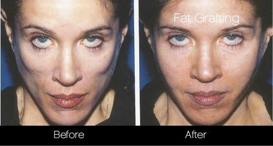 facial fat grafting before and after