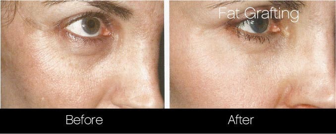 facial fat grafting before and after