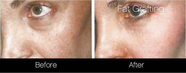 facial fat grafting before and after