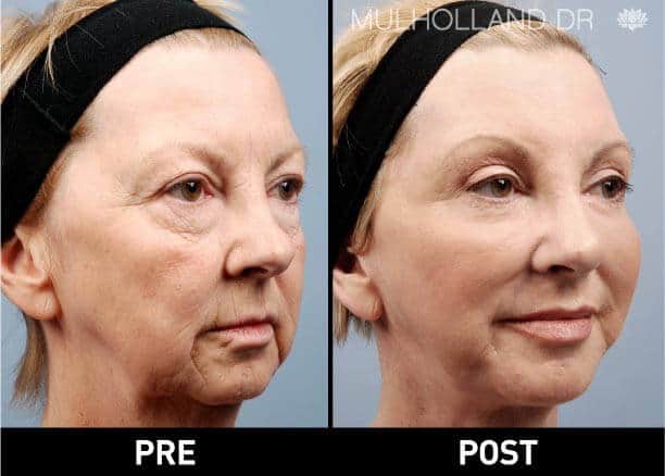 facial fat grafting before and after