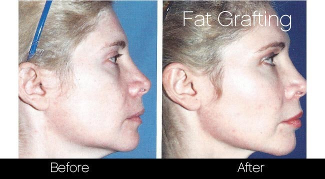 facial fat grafting before and after