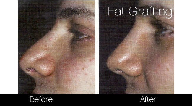 facial fat grafting before and after