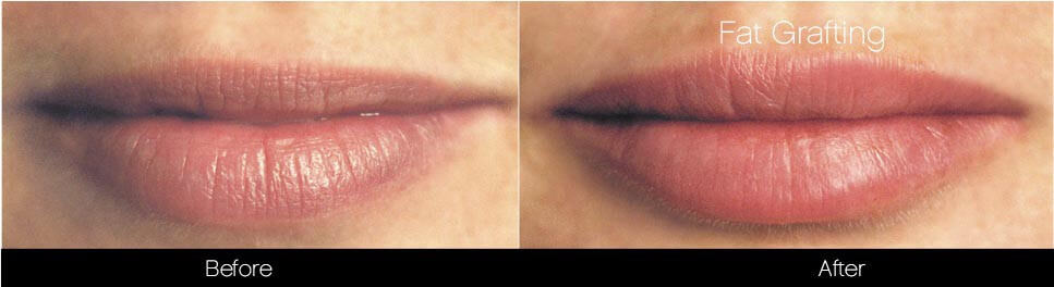 lip fat grafting before and after