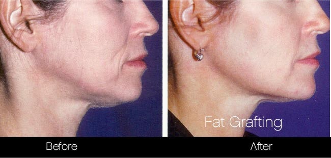 facial fat grafting before and after