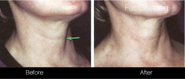 facial fat grafting before and after