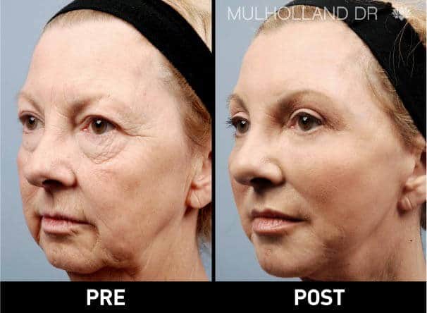 facial fat grafting before and after