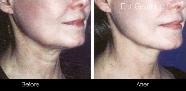 facial fat grafting before and after