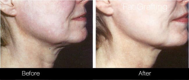 facial fat grafting before and after