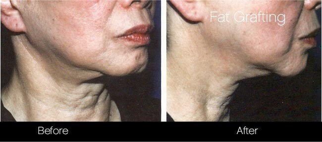 facial fat grafting before and after